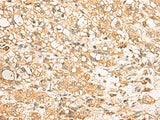 Immunohistochemistry of paraffin-embedded Human liver cancer tissue using USP24 Polyclonal Antibody at dilution of 1:35(×200)