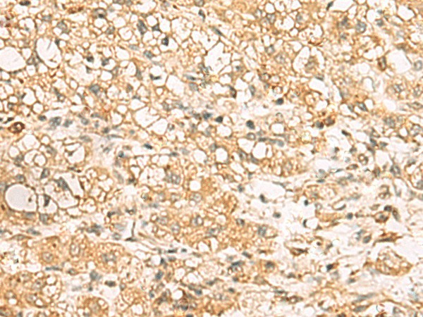 Immunohistochemistry of paraffin-embedded Human liver cancer tissue using USP24 Polyclonal Antibody at dilution of 1:35(×200)