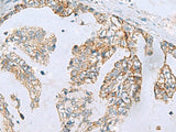 Immunohistochemistry of paraffin-embedded Human gastric cancer tissue using MGME1 Polyclonal Antibody at dilution of 1:70(×200)
