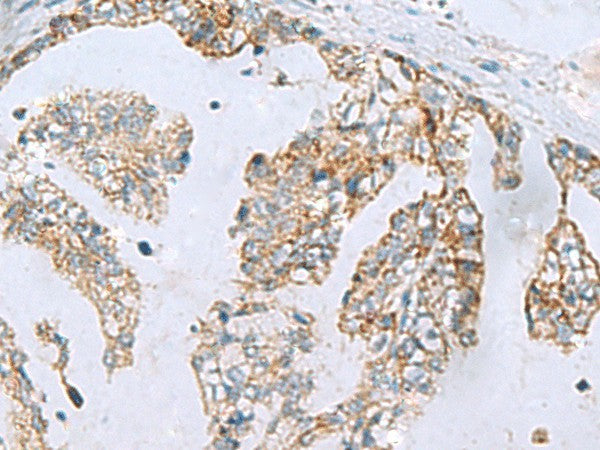 Immunohistochemistry of paraffin-embedded Human gastric cancer tissue using MGME1 Polyclonal Antibody at dilution of 1:70(×200)
