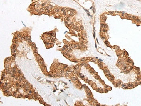 Immunohistochemistry of paraffin-embedded Human thyroid cancer tissue using HOXB9 Polyclonal Antibody at dilution of 1:45(×200)