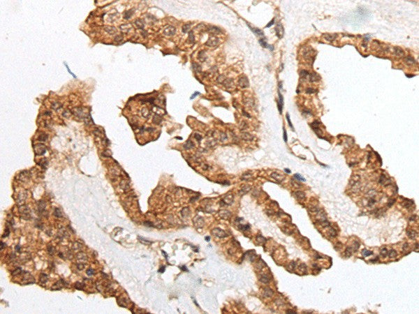 Immunohistochemistry of paraffin-embedded Human thyroid cancer tissue using HOXB9 Polyclonal Antibody at dilution of 1:45(×200)