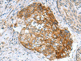 Immunohistochemistry of paraffin-embedded Human cervical cancer tissue using AP1S3 Polyclonal Antibody at dilution of 1:55(×200)