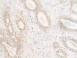 Immunohistochemistry of paraffin-embedded Human breast cancer tissue using GPR157 Polyclonal Antibody at dilution of 1:60(×200)