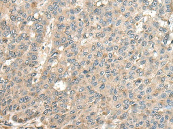 Immunohistochemistry of paraffin-embedded Human liver cancer tissue using CASQ1 Polyclonal Antibody at dilution of 1:100(×200)