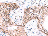 Immunohistochemistry of paraffin-embedded Human esophagus cancer tissue using IRF2BP1 Polyclonal Antibody at dilution of 1:40(×200)