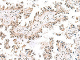Immunohistochemistry of paraffin-embedded Human lung cancer tissue using KCTD13 Polyclonal Antibody at dilution of 1:50(×200)