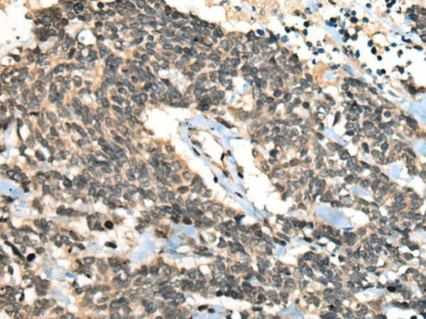 Immunohistochemistry of paraffin-embedded Human lung cancer tissue using CCNB1IP1 Polyclonal Antibody at dilution of 1:30(×200)