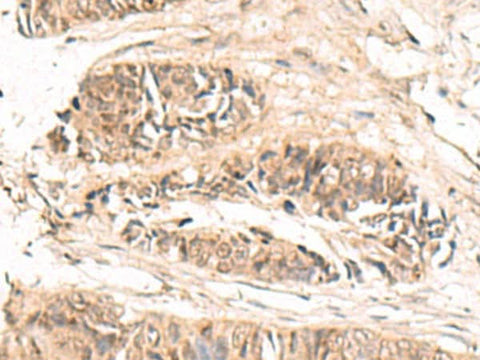 Immunohistochemistry of paraffin-embedded Human colorectal cancer tissue using ABCB4 Polyclonal Antibody at dilution of 1:70(×200)
