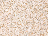 Immunohistochemistry of paraffin-embedded Human gastric cancer tissue using SETD1A Polyclonal Antibody at dilution of 1:25(×200)