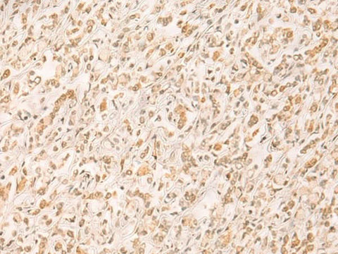 Immunohistochemistry of paraffin-embedded Human gastric cancer tissue using SETD1A Polyclonal Antibody at dilution of 1:25(×200)