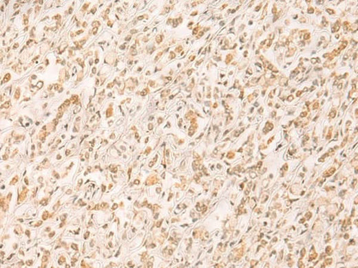 Immunohistochemistry of paraffin-embedded Human gastric cancer tissue using SETD1A Polyclonal Antibody at dilution of 1:25(×200)