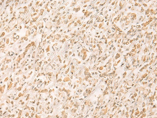 Immunohistochemistry of paraffin-embedded Human gastric cancer tissue using SETD1A Polyclonal Antibody at dilution of 1:25(×200)