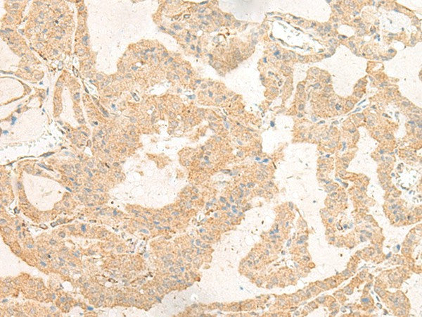 Immunohistochemistry of paraffin-embedded Human thyroid cancer tissue using GNAT3 Polyclonal Antibody at dilution of 1:40(×200)