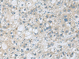 Immunohistochemistry of paraffin-embedded Human liver cancer tissue using KCNJ2 Polyclonal Antibody at dilution of 1:35(×200)