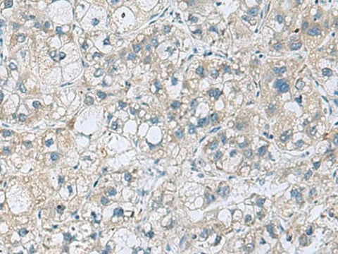 Immunohistochemistry of paraffin-embedded Human liver cancer tissue using KCNJ2 Polyclonal Antibody at dilution of 1:35(×200)