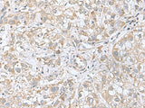 Immunohistochemistry of paraffin-embedded Human liver cancer tissue using CGB5 Polyclonal Antibody at dilution of 1:55(×200)