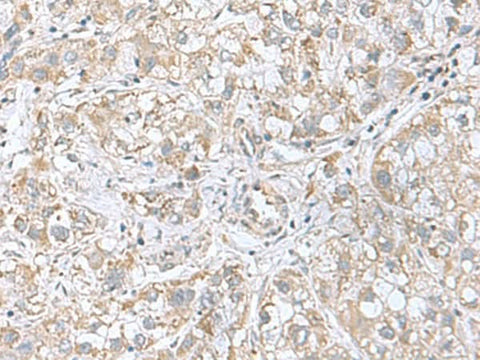 Immunohistochemistry of paraffin-embedded Human liver cancer tissue using CGB5 Polyclonal Antibody at dilution of 1:55(×200)