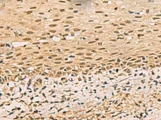Immunohistochemistry of paraffin-embedded Human cervical cancer tissue using FOXH1 Polyclonal Antibody at dilution of 1:40(×200)