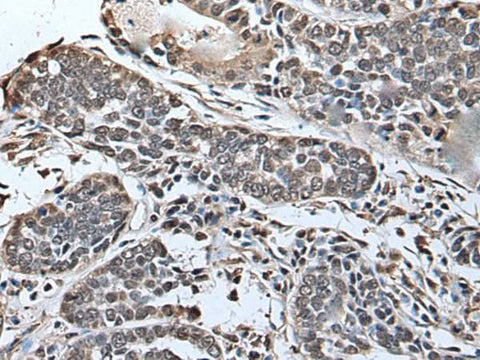 Immunohistochemistry of paraffin-embedded Human esophagus cancer tissue using SLITRK5 Polyclonal Antibody at dilution of 1:45(×200)