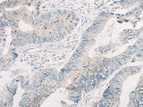Immunohistochemistry of paraffin-embedded Human colorectal cancer tissue using WNK4 Polyclonal Antibody at dilution of 1:45(×200)