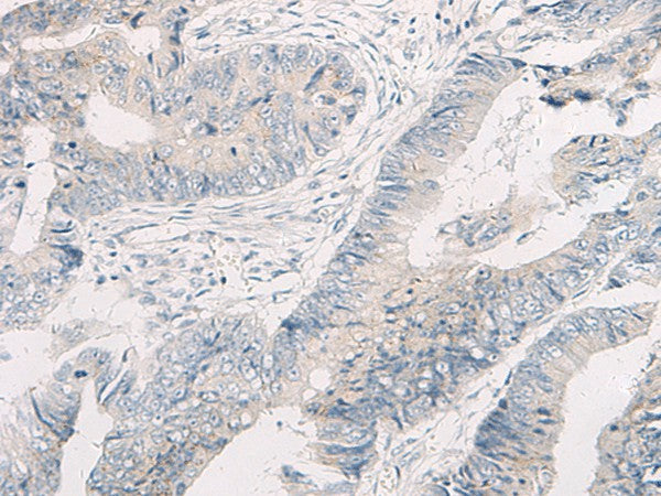 Immunohistochemistry of paraffin-embedded Human colorectal cancer tissue using WNK4 Polyclonal Antibody at dilution of 1:45(×200)