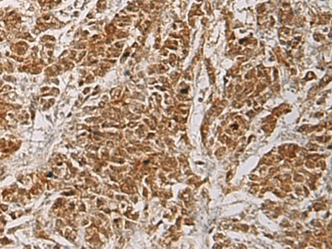 Immunohistochemistry of paraffin-embedded Human colorectal cancer tissue using HOXC5 Polyclonal Antibody at dilution of 1:55(×200)