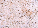 Immunohistochemistry of paraffin-embedded Human liver cancer tissue using DDI2 Polyclonal Antibody at dilution of 1:50(×200)