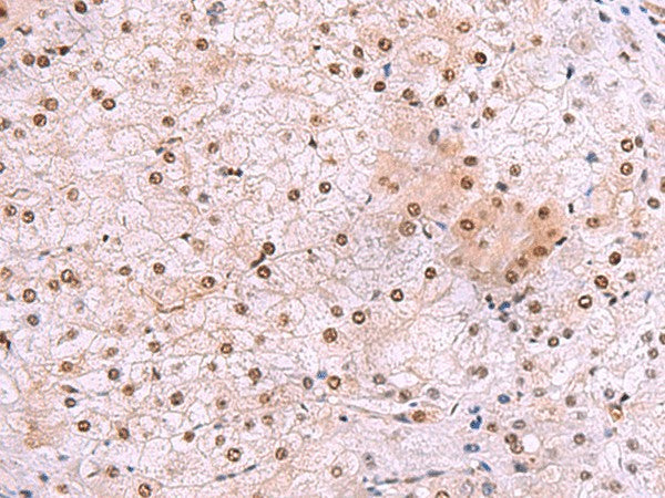 Immunohistochemistry of paraffin-embedded Human liver cancer tissue using DDI2 Polyclonal Antibody at dilution of 1:50(×200)