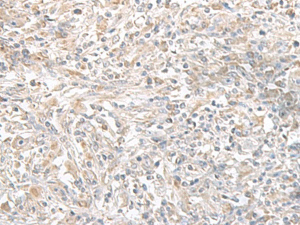 Immunohistochemistry of paraffin-embedded Human liver cancer tissue using PFKM Polyclonal Antibody at dilution of 1:50(×200)