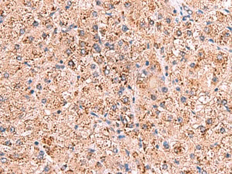 Immunohistochemistry of paraffin-embedded Human liver cancer tissue using OSBPL2 Polyclonal Antibody at dilution of 1:65(×200)