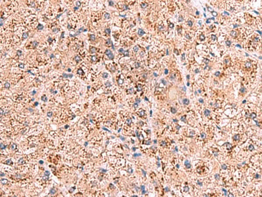 Immunohistochemistry of paraffin-embedded Human liver cancer tissue using OSBPL2 Polyclonal Antibody at dilution of 1:65(×200)