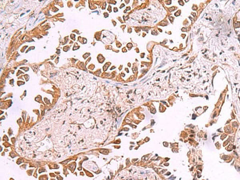 Immunohistochemistry of paraffin-embedded Human lung cancer tissue using AK9 Polyclonal Antibody at dilution of 1:85(×200)