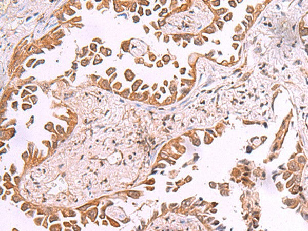 Immunohistochemistry of paraffin-embedded Human lung cancer tissue using AK9 Polyclonal Antibody at dilution of 1:85(×200)