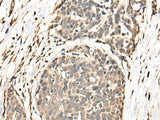 Immunohistochemistry of paraffin-embedded Human thyroid cancer tissue using BATF Polyclonal Antibody at dilution of 1:40(×200)