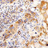 Immunohistochemistry analysis of paraffin-embedded human lymphoma using UCP2 Polyclonal Antibody at dilution of 1:300.