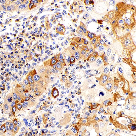 Immunohistochemistry analysis of paraffin-embedded human lymphoma using UCP2 Polyclonal Antibody at dilution of 1:300.