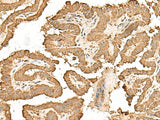 Immunohistochemistry of paraffin-embedded Human thyroid cancer tissue using RPS25 Polyclonal Antibody at dilution of 1:65(×200)