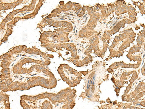 Immunohistochemistry of paraffin-embedded Human thyroid cancer tissue using RPS25 Polyclonal Antibody at dilution of 1:65(×200)