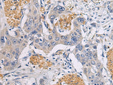 Immunohistochemistry of paraffin-embedded Human esophagus cancer tissue using CHST3 Polyclonal Antibody at dilution of 1:30(×200)