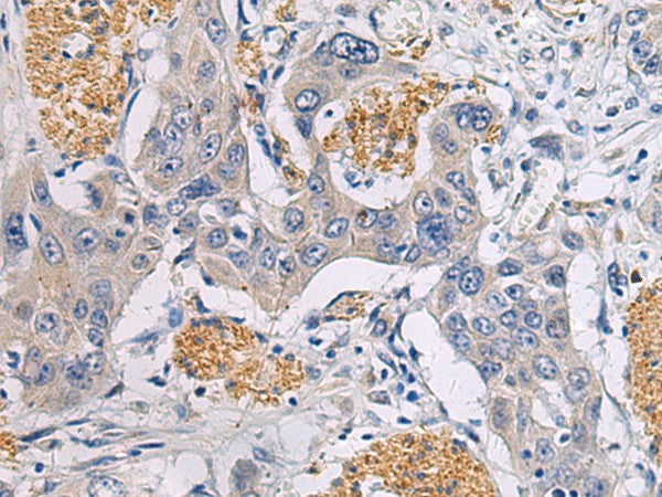Immunohistochemistry of paraffin-embedded Human esophagus cancer tissue using CHST3 Polyclonal Antibody at dilution of 1:30(×200)