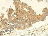 Immunohistochemistry of paraffin-embedded Human colorectal cancer tissue using TMEM9 Polyclonal Antibody at dilution of 1:50(×200)