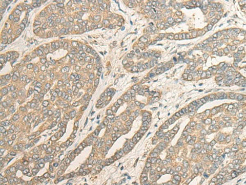 Immunohistochemistry of paraffin-embedded Human liver cancer tissue using MYOZ2 Polyclonal Antibody at dilution of 1:40(×200)