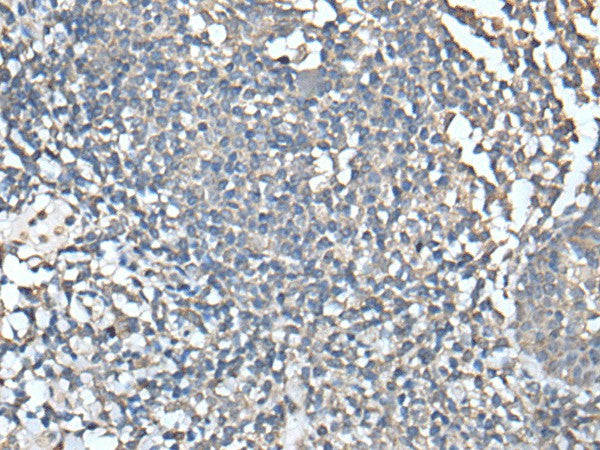 Immunohistochemistry of paraffin-embedded Human tonsil tissue using UBASH3A Polyclonal Antibody at dilution of 1:50(×200)