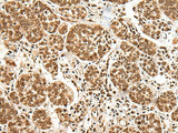 Immunohistochemistry of paraffin-embedded Human esophagus cancer tissue using BRSK1 Polyclonal Antibody at dilution of 1:95(×200)