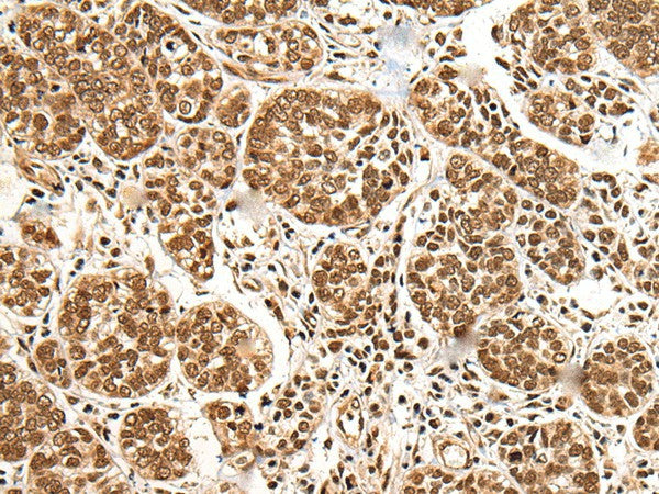 Immunohistochemistry of paraffin-embedded Human esophagus cancer tissue using BRSK1 Polyclonal Antibody at dilution of 1:95(×200)