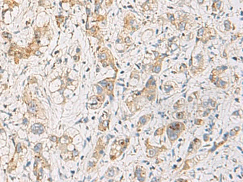 Immunohistochemistry of paraffin-embedded Human liver cancer tissue using FYCO1 Polyclonal Antibody at dilution of 1:110(×200)