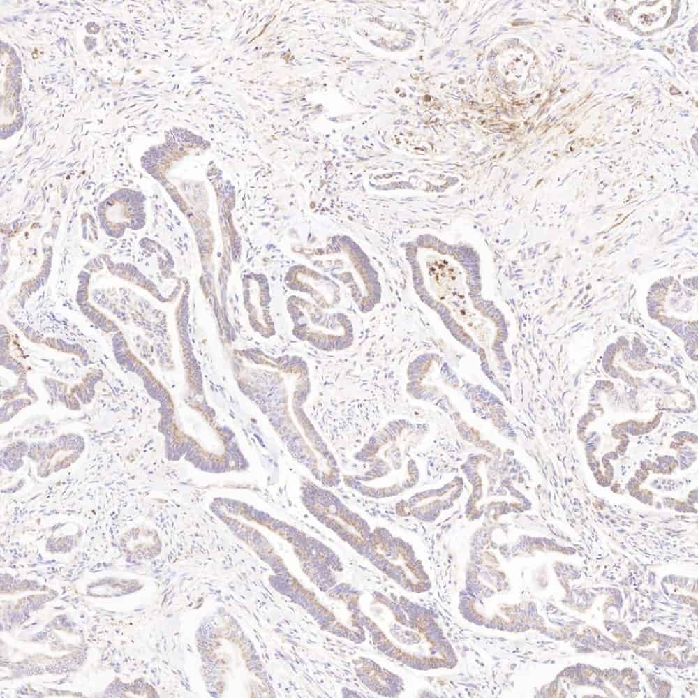 Immunohistochemistry analysis of paraffin-embedded human colon cancer using MMP2 Polyclonal Antibody at dilution of 1:500.
