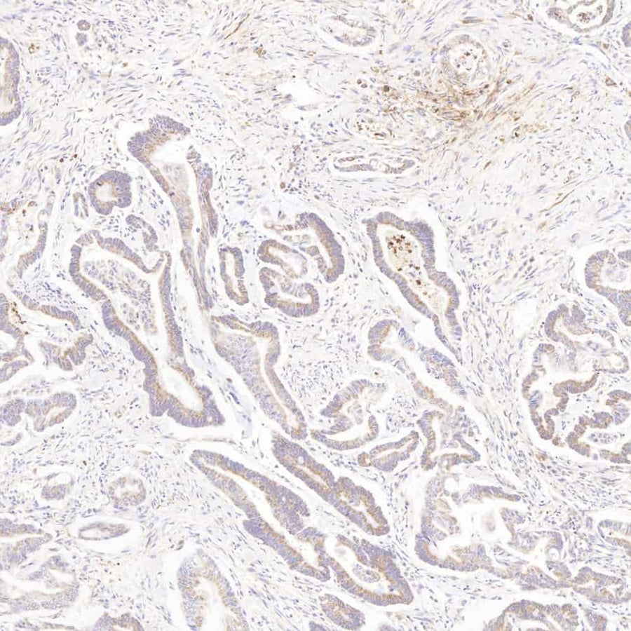 Immunohistochemistry analysis of paraffin-embedded human colon cancer using MMP2 Polyclonal Antibody at dilution of 1:500.