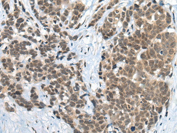 Immunohistochemistry of paraffin-embedded Human thyroid cancer tissue using ZNF83 Polyclonal Antibody at dilution of 1:50(×200)